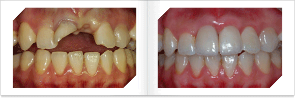 파절된 치아를 임플란트를 매식하고 전부도재 수복후 모습