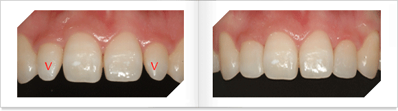 선천적 형태이상 치아의 직접심미 레진수복전 모습과 수복후 모습