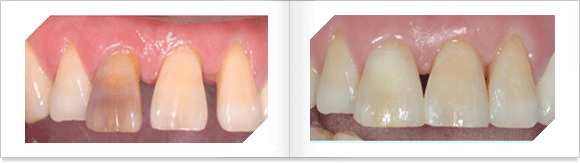 변색된 치아에 대한 실활치미백과 치간공극폐쇄 수복후 모습