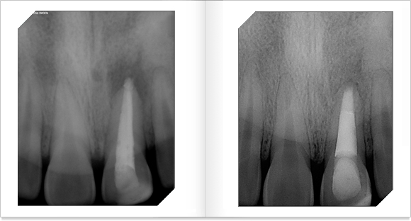 x-ray 치아가 공간이 생겨 비어 있는 모습과 근관치료후 공간이 채워진 모습