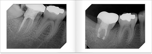 치아 재이식, x-ray 사진