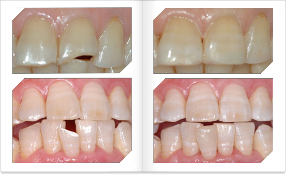 치아 일부가 파절이 된 모습과 복원된 모습