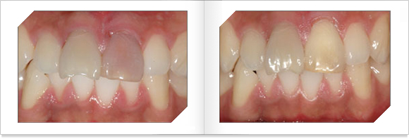 치아 일부가 변색된 모습과 치료후 동일한 색상의 치아 모습