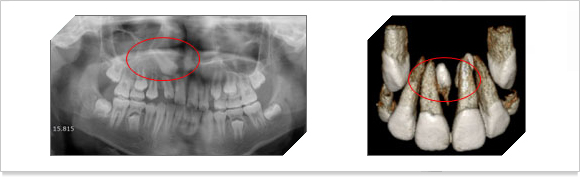 매복된 치아의 x-ray 사진과 치아 모습