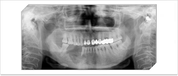 치아를 턱뼈에 통증을 느끼고 있는 증상의 x-ray 사진