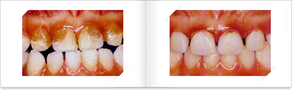 Strip crown 치료전 충치와 치아 사이가 많이 벌어져 있는 모습 우측사진은 치료후 충치가제거되고 치아배열도 고르게 정리된 모습