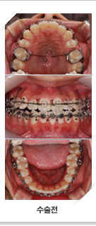 수술전 보철로 치아를 교정한 모습 아래,정면,윗치아모습