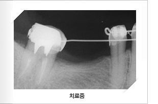 구치직립 치료중 x-ray 사진