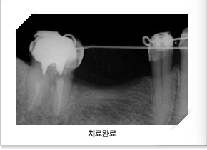 구치직립 치료완료 x-ray 사진