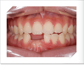 구치함입된 치료후 정면 치아 사진