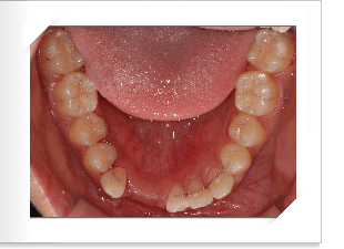 구치함입된 치료후 측면 치아 사진