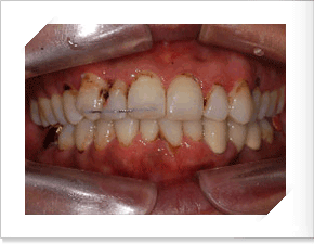 치아조절 후 정면사진