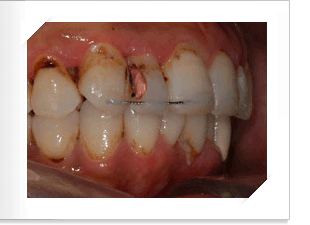 치아조절 후 측면사진