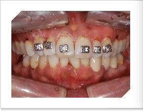 치아조절을 위한 치료전 정면 사진