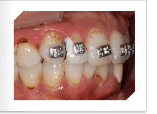 치아조절을 위한 치료전 측면 사진