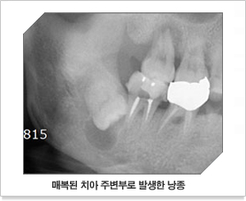 매복된 치아 주변부로 발생한 낭종