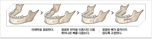 아래턱을 절골한다 절골된 하악을 이동시킨다음 튀어나온 뼈를 다듬는다 절골된뼈가 움직이지 않도록 고정한다