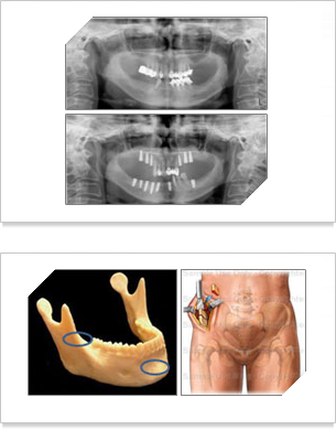 x-ray사진과 자가골을 이용시 아래턱,부분위,양측하악지부위,골반쪽의 엉치뼈 부분의 사진
