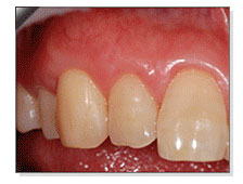 치근피개술 치료후 치아 뿌리가 가려져 안보이는 모습