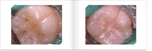 치아에 홈이 생긴 부분을 메우는 사진 왼쪽 홈메우기 전 많이 페인 모습 오른쪽 홈을 메운후 완만해진 모습