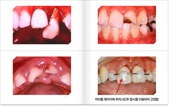  치아가 손상된 3개의 사진과 치아를 제자리에 위치신후 철사를 이용해서 고정시킨 모습 
