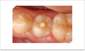 치아의 교합면에 혹처럼 치질이 올라온 사진